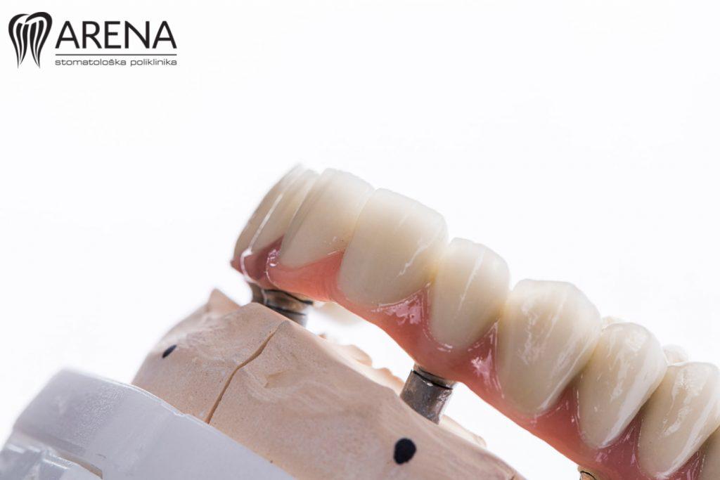 Fiksna zubna proteza