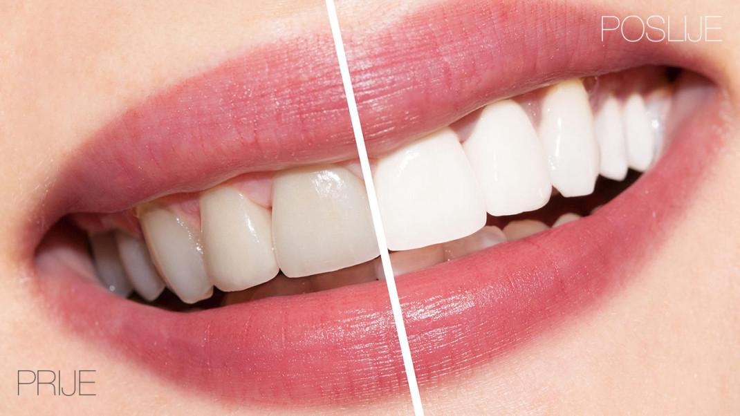 Prikaz razlike između žutih zuba i zuba podvrgnutim izbjeljivanjem.