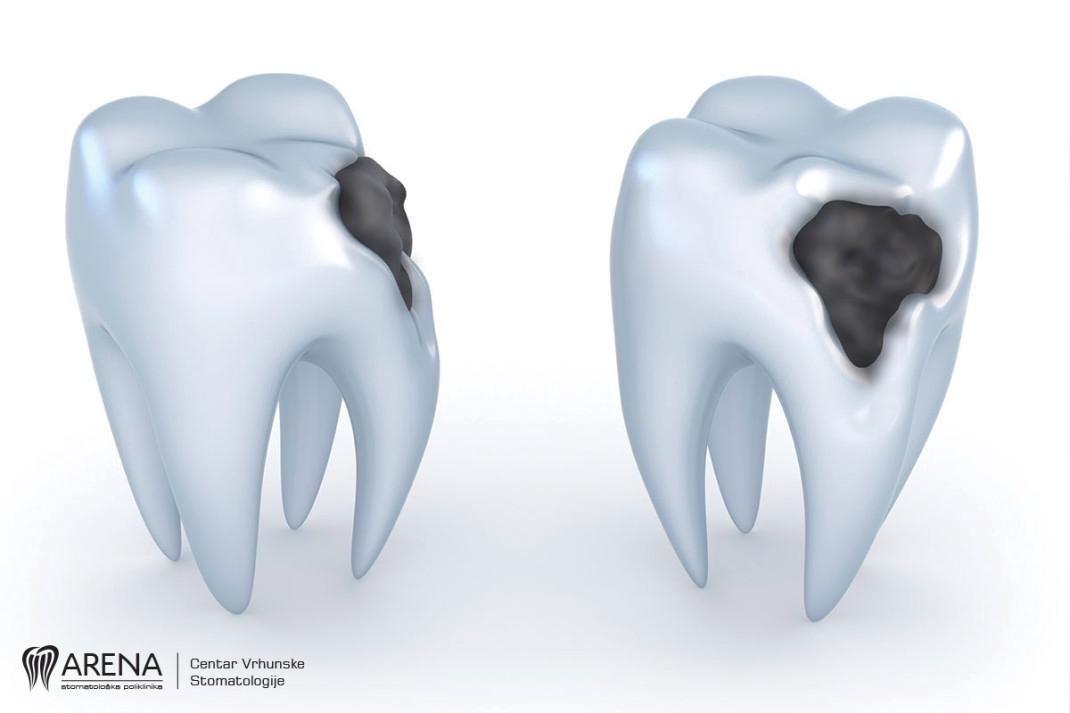 3D model zuba zahvaćenim karijesom.