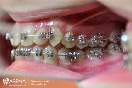 Stanje zubi na samom početku ortodonske terapije s fiksnim aparatićem s metalnim bravicama.