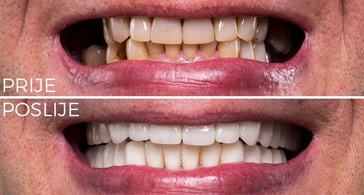 zubni-implantati-prije-poslije