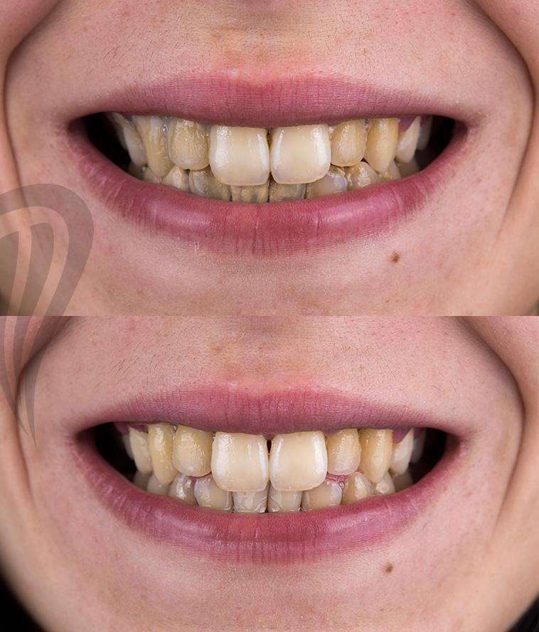 Prije i poslije zahvata odtranivanje zubnog kamenca.