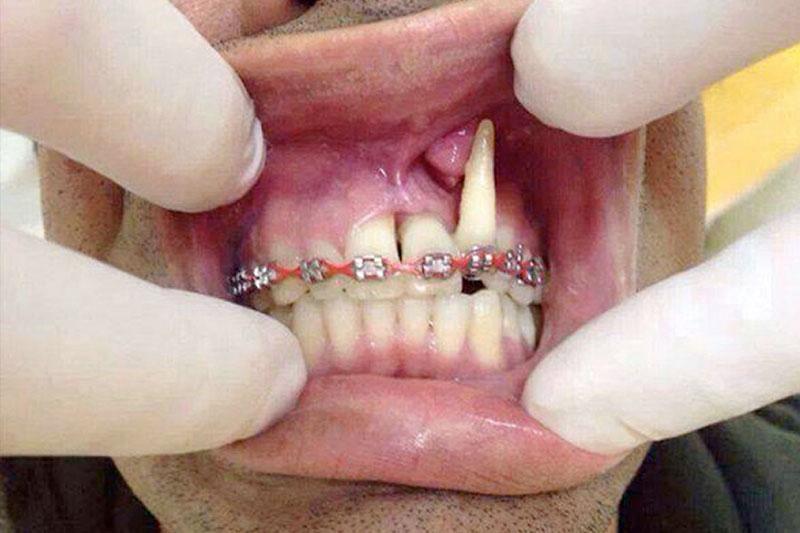 Nestručno provedena ortodontska terapija u kojem je krojen zuba izbačen iz mjesta.