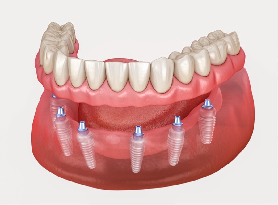 Medicinski precizna 3D ilustracija fiksne proteze na 4 ili 6 implantata