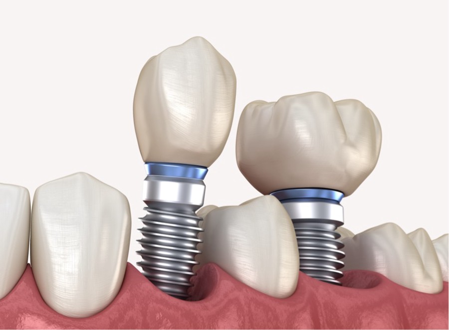 Medicinski precizna 3D ilustracija zubnih implantata